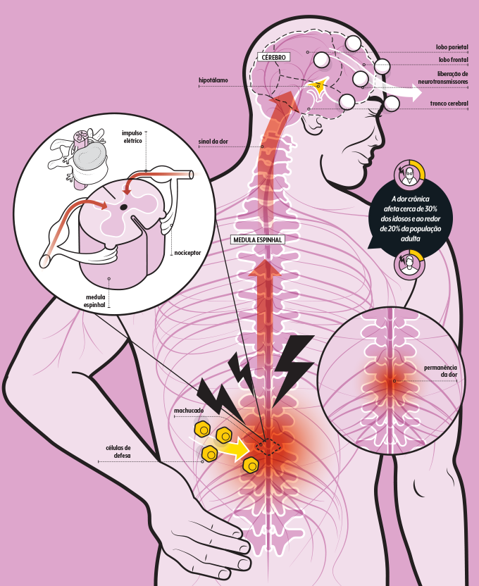 ilustração sobre dor crônica 