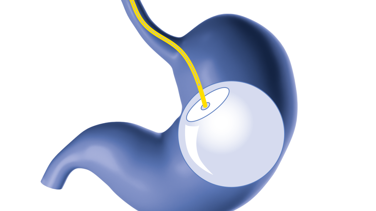 estomago-cirurgia-com-capsula-deglutivel