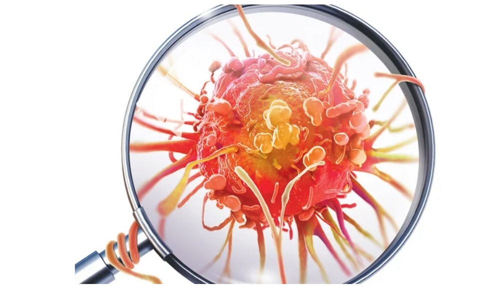 Termografia não detecta câncer de mama e pode atrasar diagnóstico