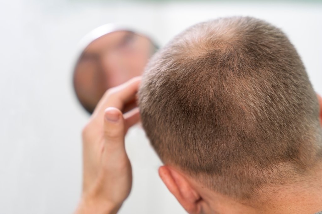 Minoxidil pode causar “síndrome do lobisomem”? Médica explica