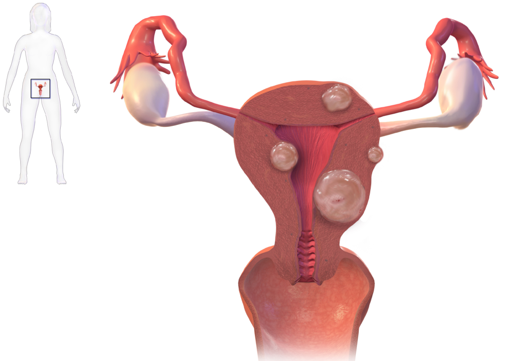 Diferentes tipos de miomas uterinos