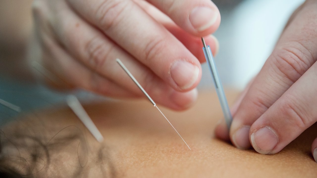 acupuntura-tratamento-dores