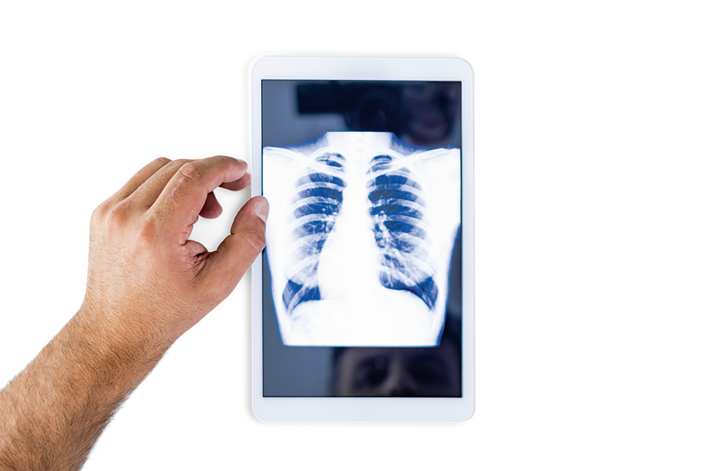 Câncer de pulmão: é hora de rastreá-lo