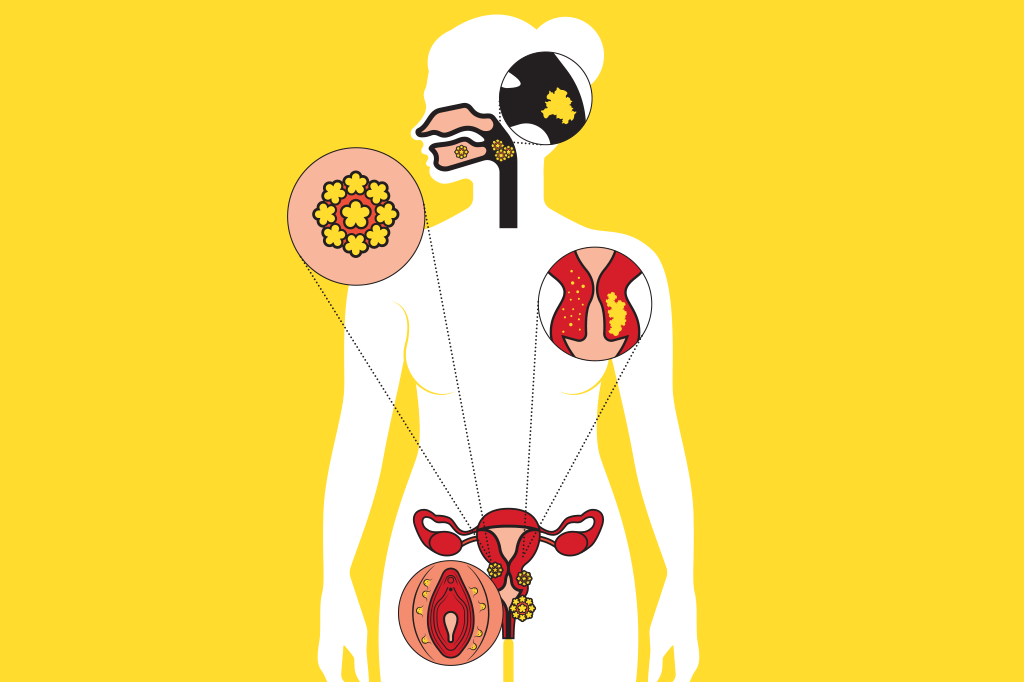 O que é o HPV e o que ele tem a ver com o câncer?