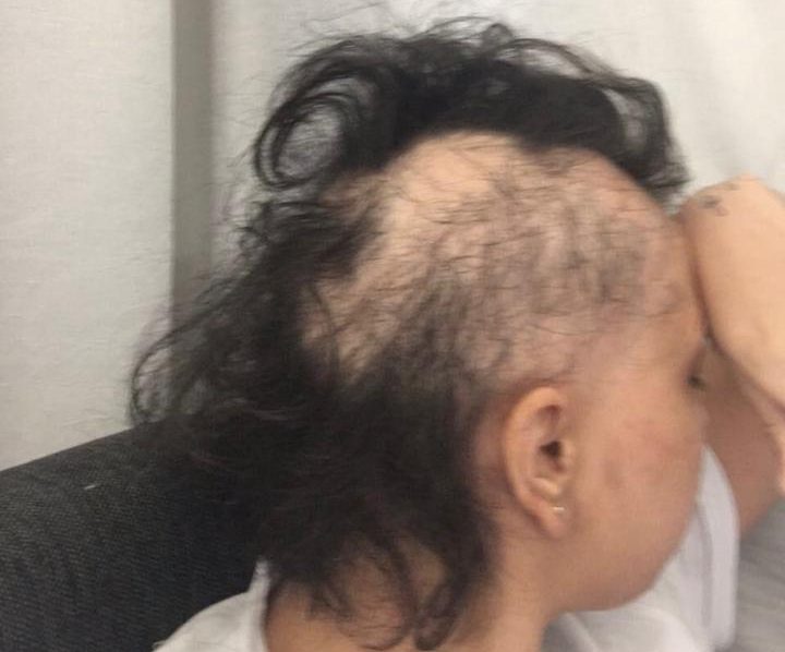 em-primeira-pessoa-alopecia-fernanda-ayub-02