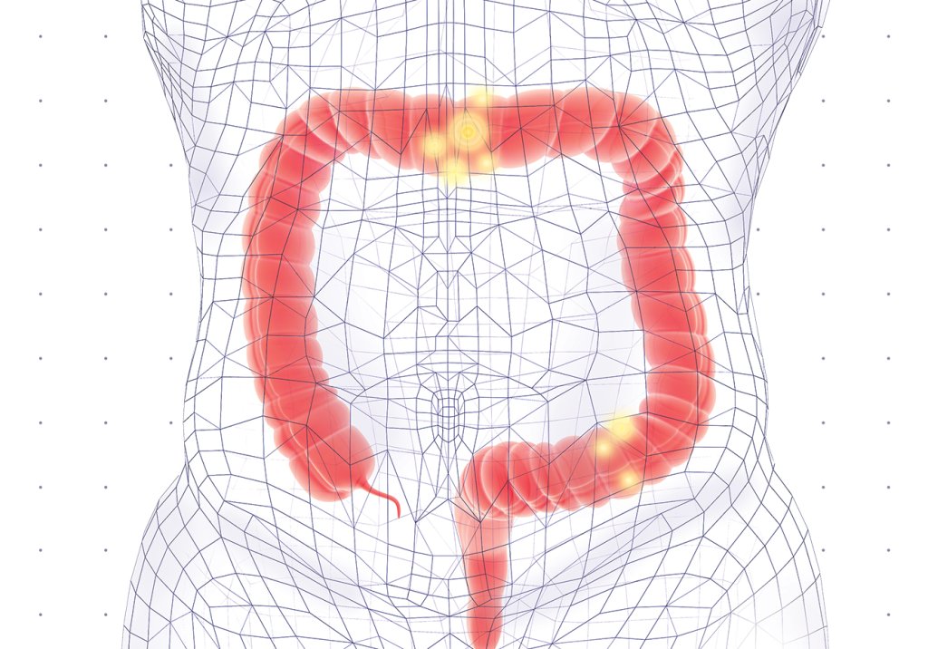 saude-cancer-colorretal-intestino-colon-reto-oncologia