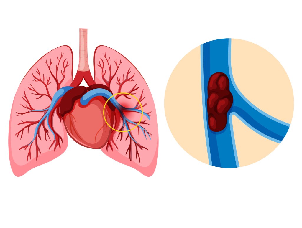 saude-embolia-pulmonar