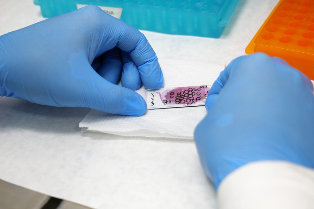 Exames genéticos podem evitar cirurgias de tireoide?