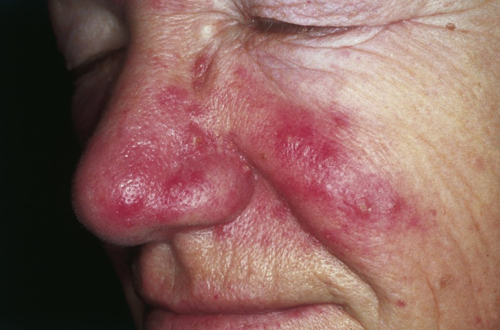 rosacea-pustulas-rosto