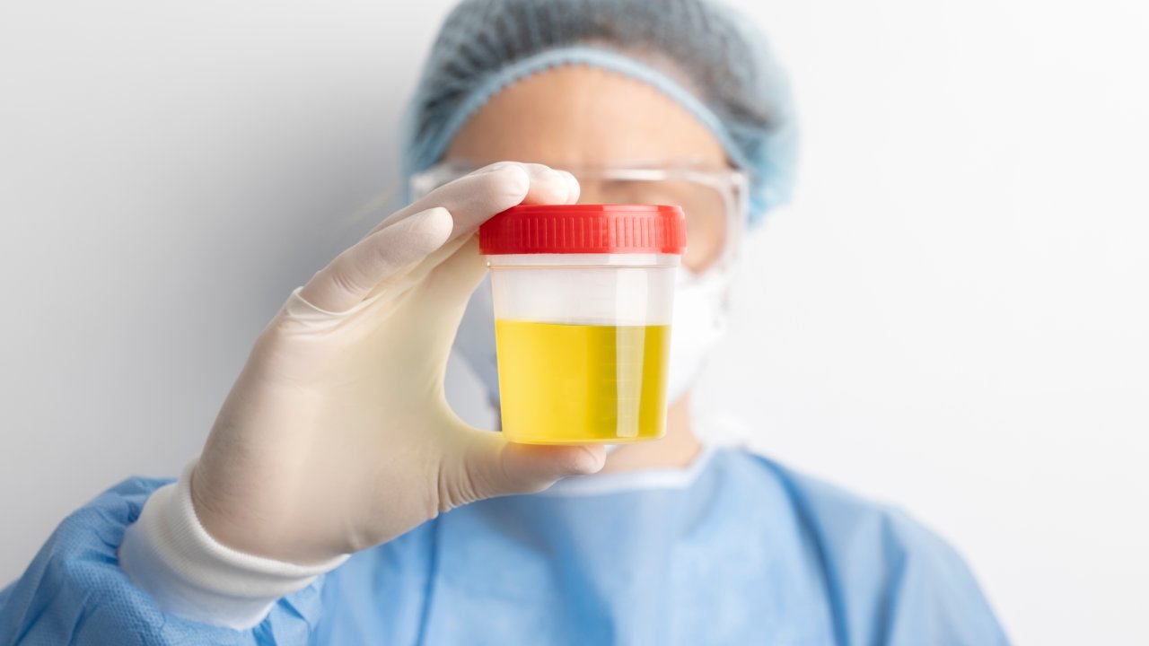 urocultura-exame-de-urina-o-que-e-quais-doencas-detecta