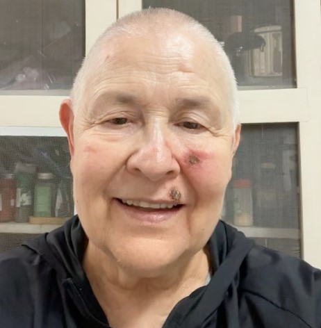 Câncer de pele de Monja Coen: por que manchas pioram com quimioterapia?