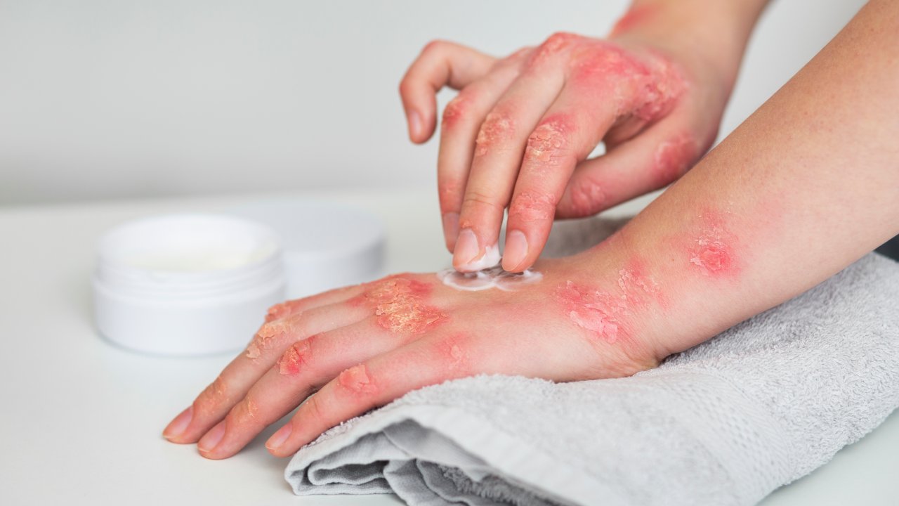 dermatite-herpetiforme-o-que-e-quais-as-causas