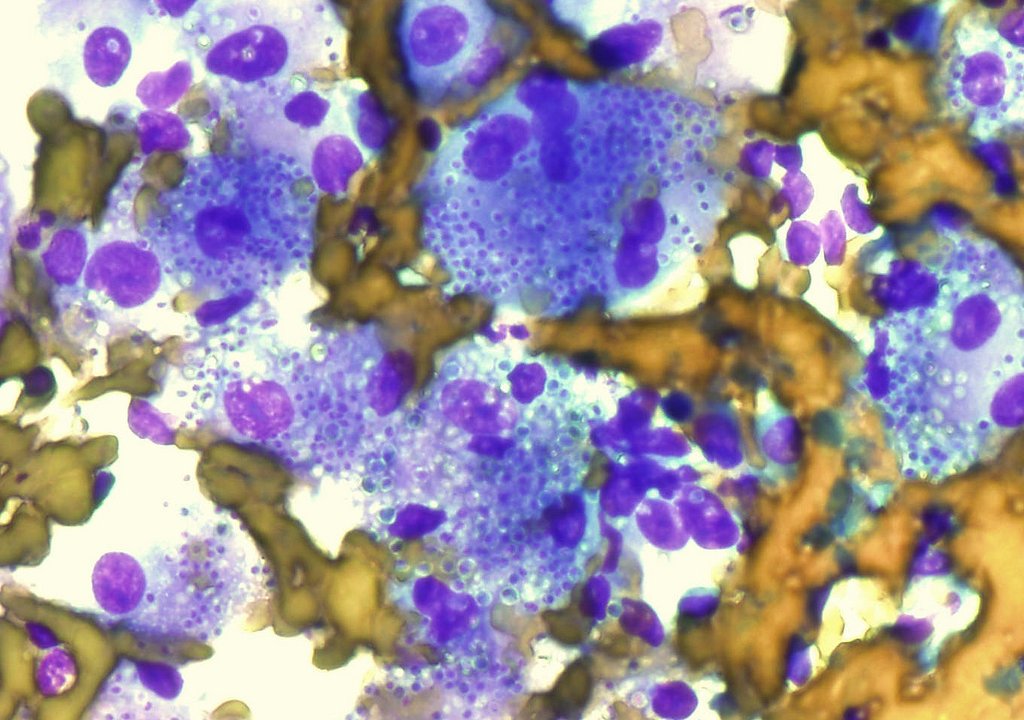 histoplasmose-histoplasma-capsulatum-fungos-infeccao