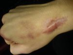 O que é queloide? Como tratar esse tipo de cicatriz?