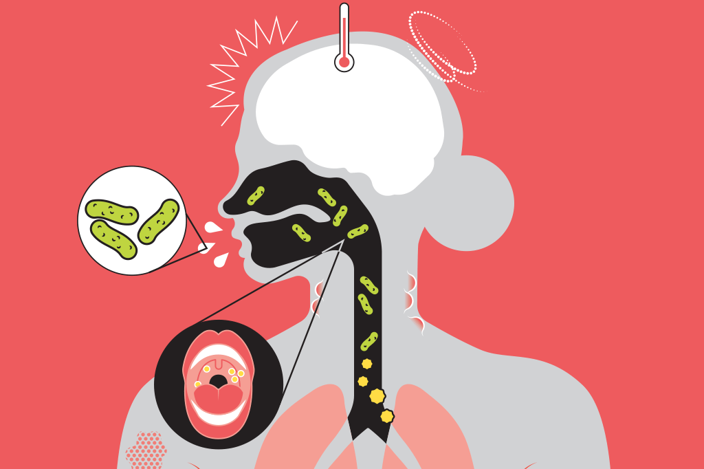 Difteria: por que a vacina continua sendo essencial?