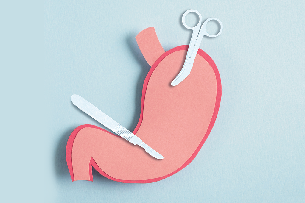 Dossiê bariátrica: 17 perguntas e respostas sobre a cirurgia