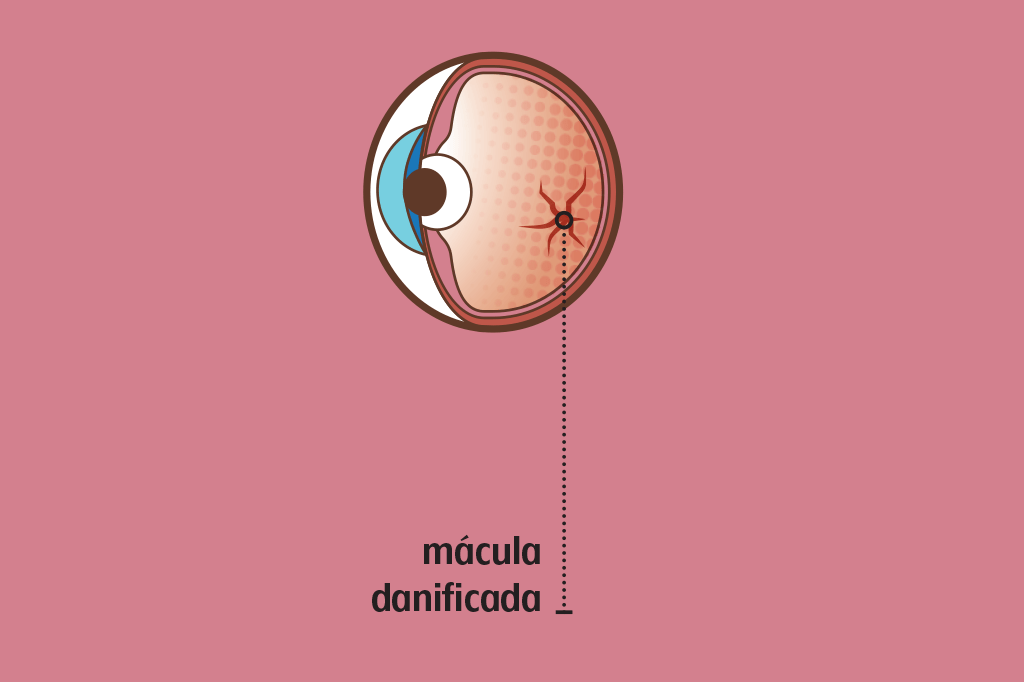 macula-diabetes