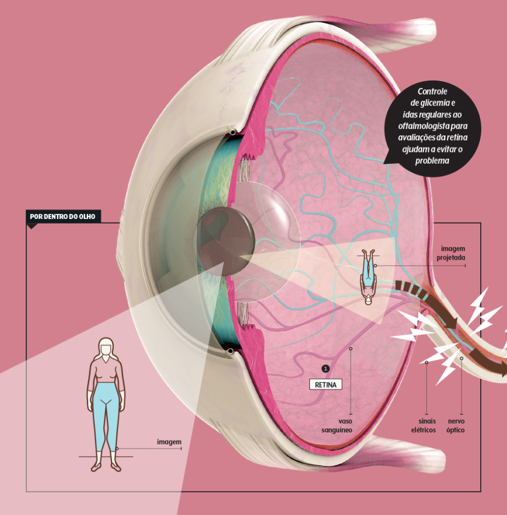 retinopatia-diabetica-como-ocorre