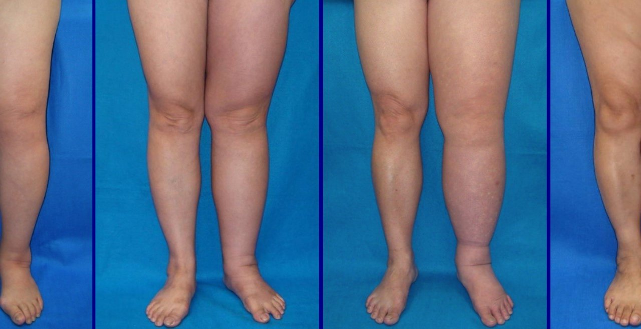linfedema-estagios