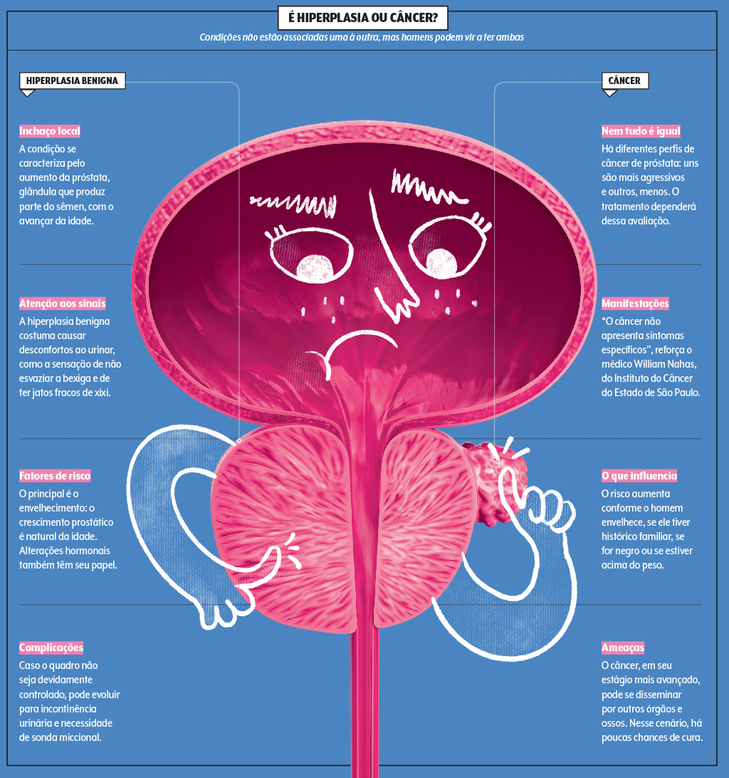 prostata-cancer-hiperplasia