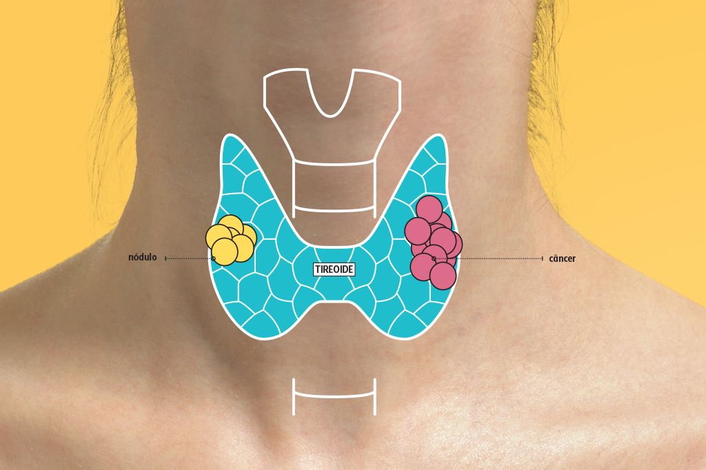 cancer-nodulo-tireoide diferenca-nodulo-tumor-tireoide