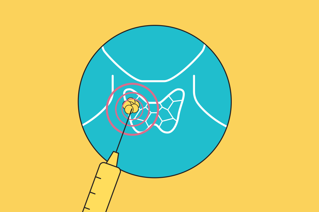nodulo-tireoide-tratamento