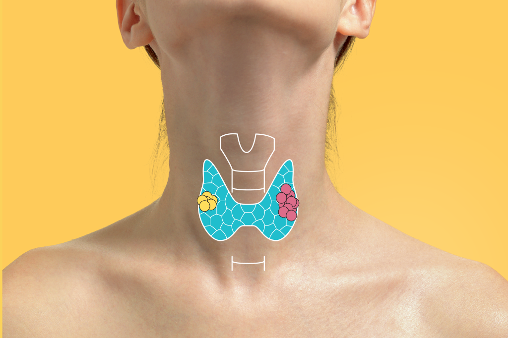 diferenca-nodulo-tumor-tireoide