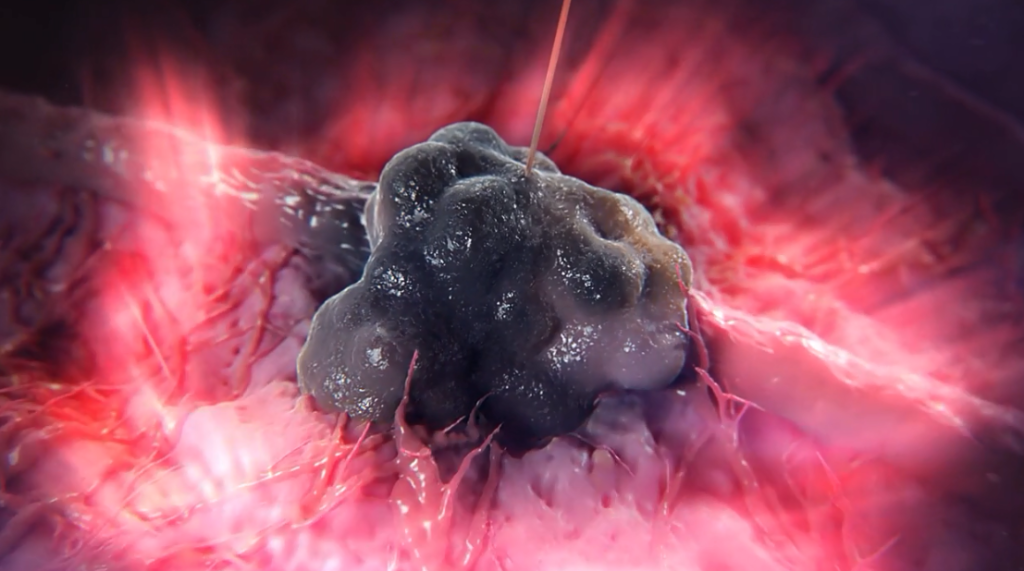 Nova técnica trata câncer de próstata em uma única sessão