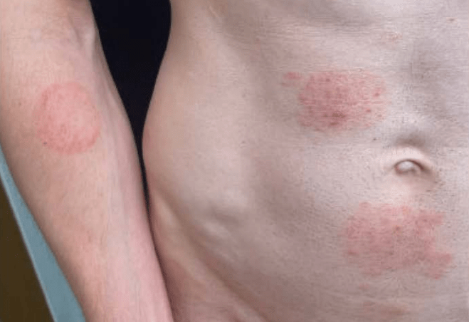 Superfungo transmitido sexualmente: o que se sabe sobre casos na Europa e EUA