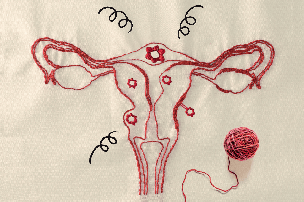 miomas-utero