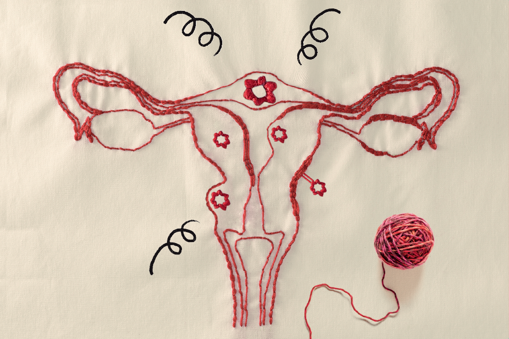 Miomas: tudo sobre o problema que atinge até 80% das mulheres