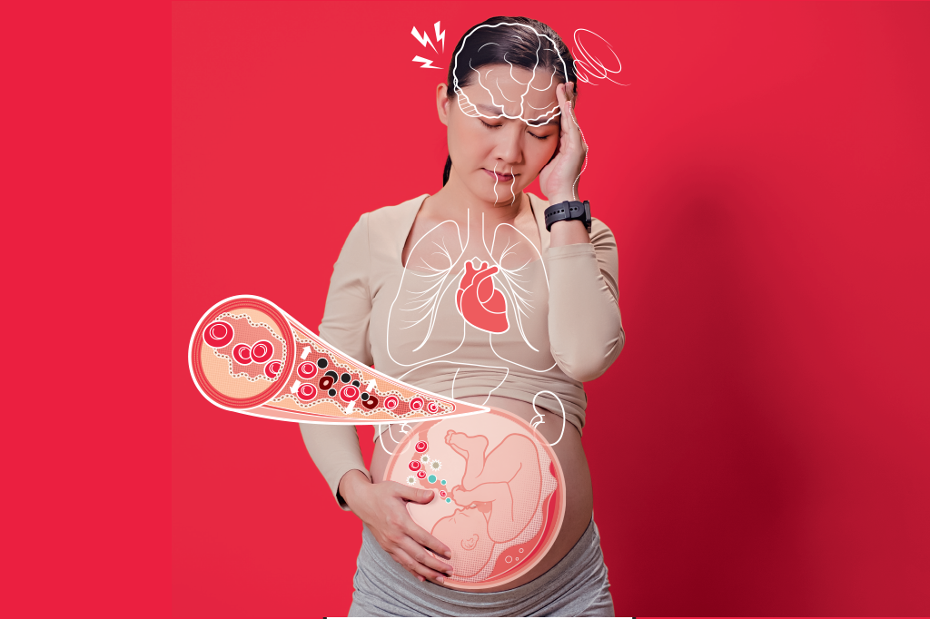 pre-eclampsia-o-que-e