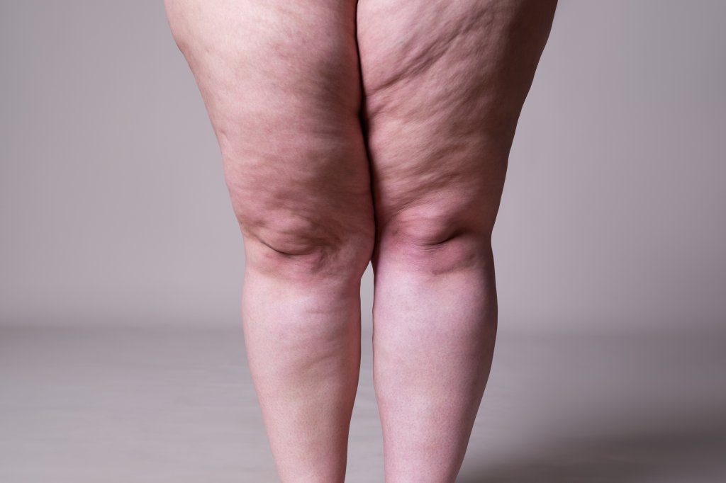 Lipedema: como a alimentação pode ajudar no controle desta condição?