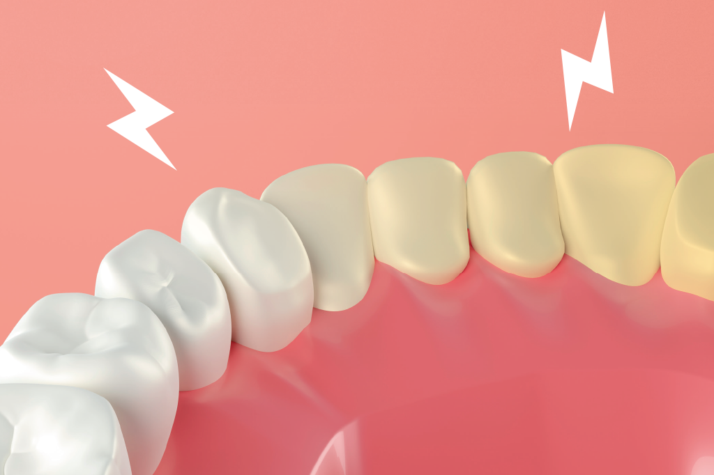 Quando a busca por dentes brancos se torna um problema?