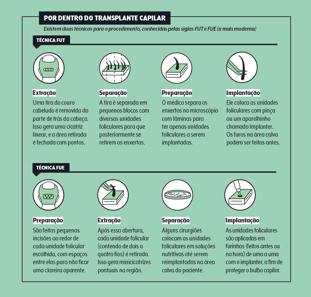 transplante-capilar-quadro-tecnicas-fut-fue