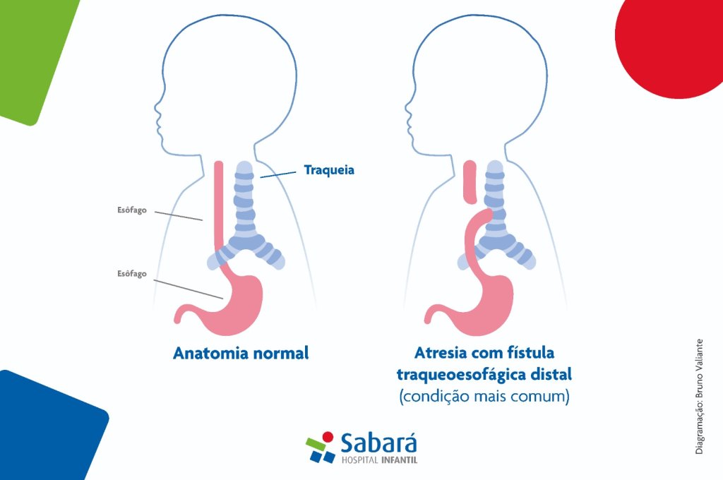 atresia-do-esofago-fistula atresia-do-esofago-fistula