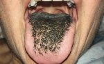 lingua-preta-pilosa