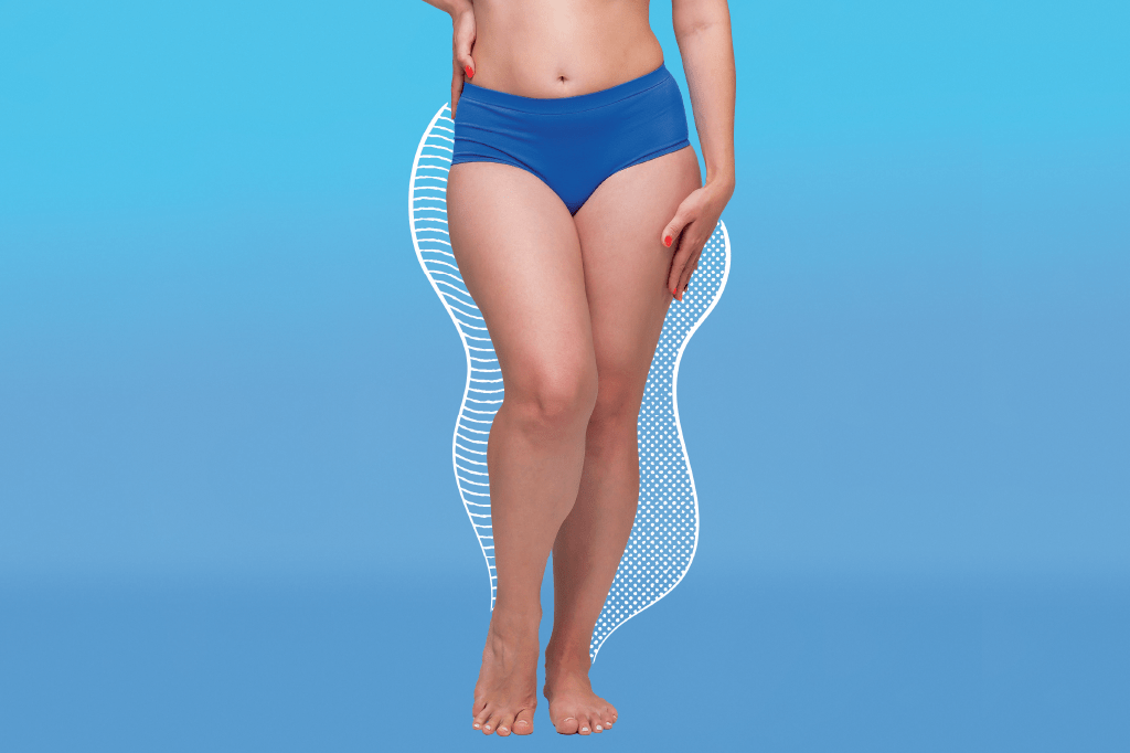 saude-medicina-lipedema