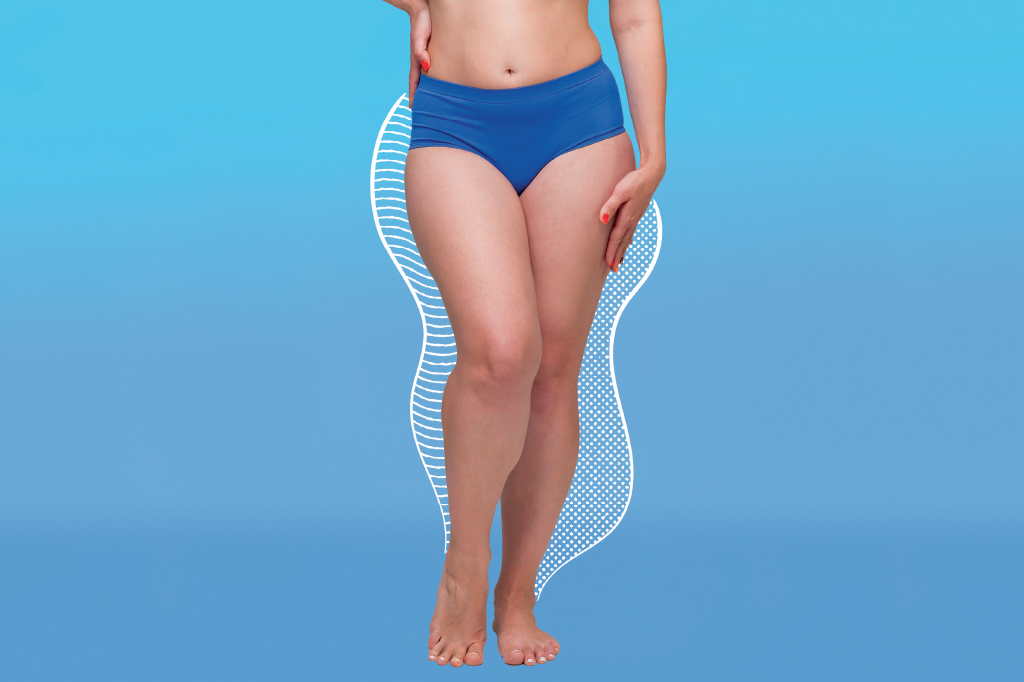 Lipedema: conheça os dilemas envolvendo a doença e fuja de ciladas no tratamento