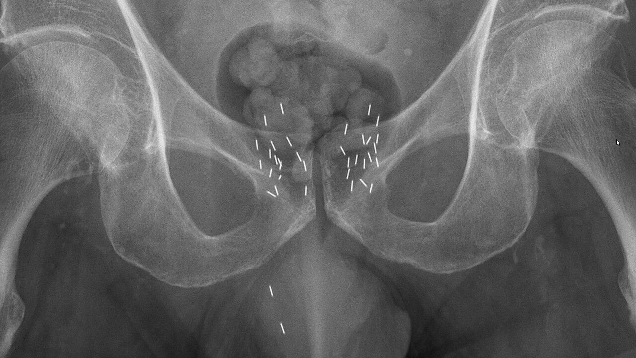 braquiterapia-radioterapia-interna