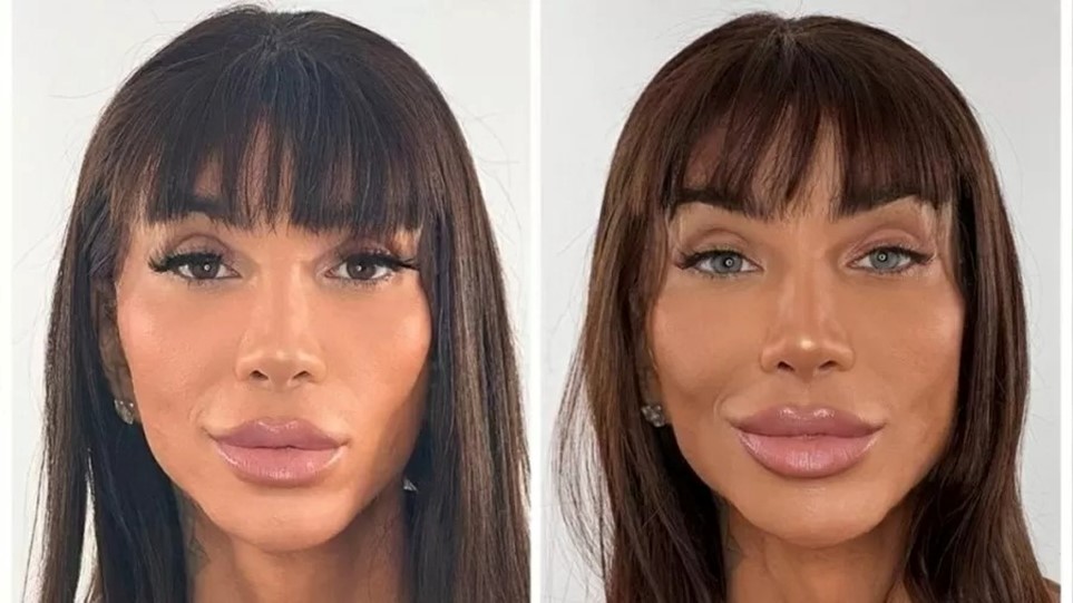 Por que você não deveria fazer cirurgia para mudar a cor dos olhos por estética