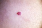 carcinoma-basocelular