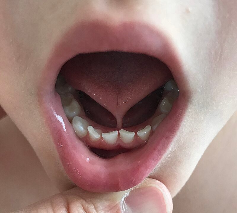 anquiloglossia-freio-lingua-frenectomia