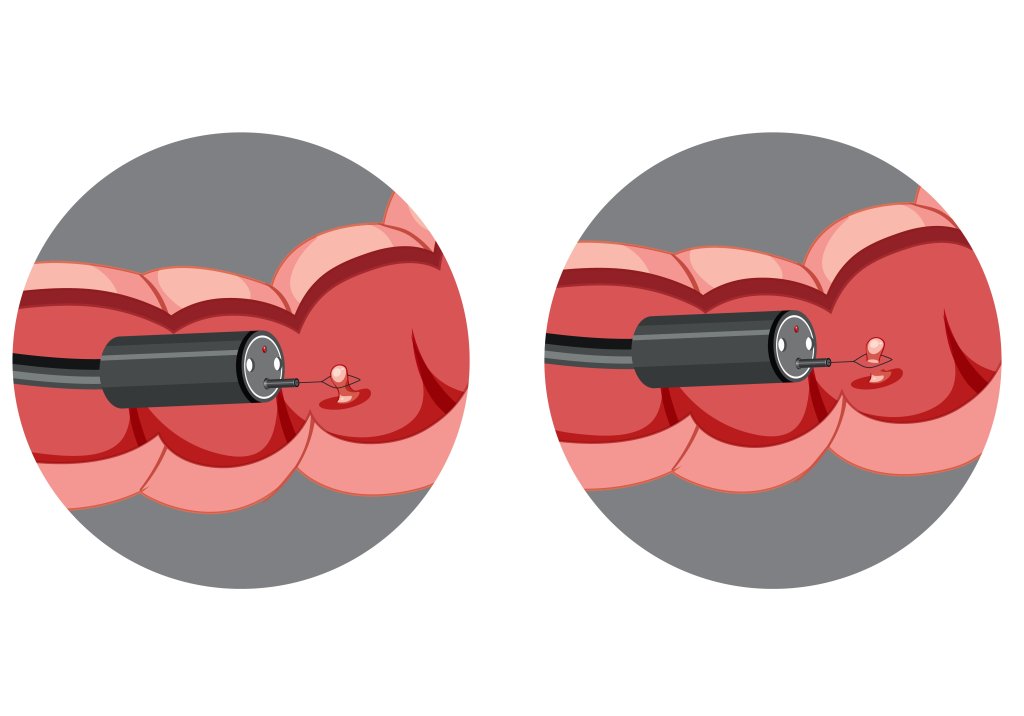 Pólipos intestinais: o que são, quais os sintomas e por que retirá-los