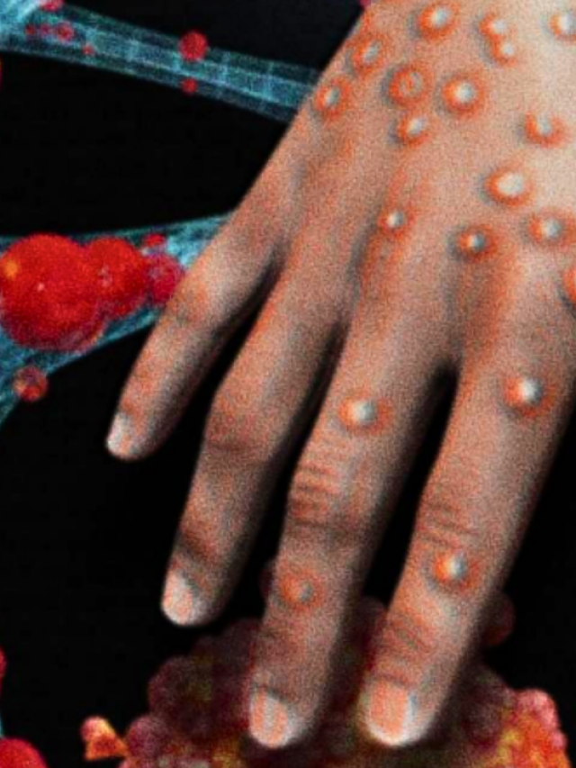 Capa de: Mpox: tudo o que você precisa saber