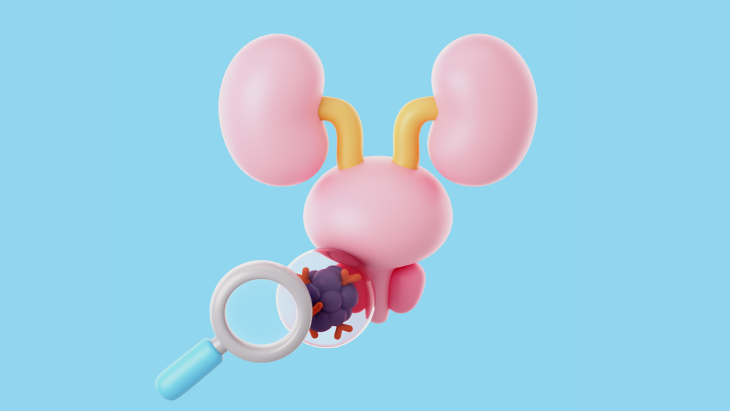 Ilustração 3D de um sistema urinário com rins e bexiga rosados, onde uma lupa examina células cancerosas roxas dentro da bexiga